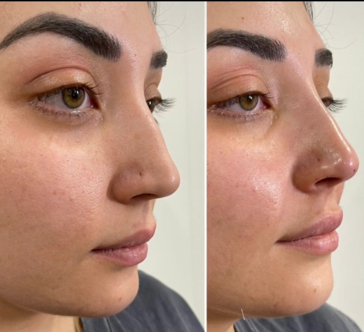 https://www.theperfectdose.com/wp-content/uploads/2024/10/Non-surgical-rhinoplasty-bxa3.jpg